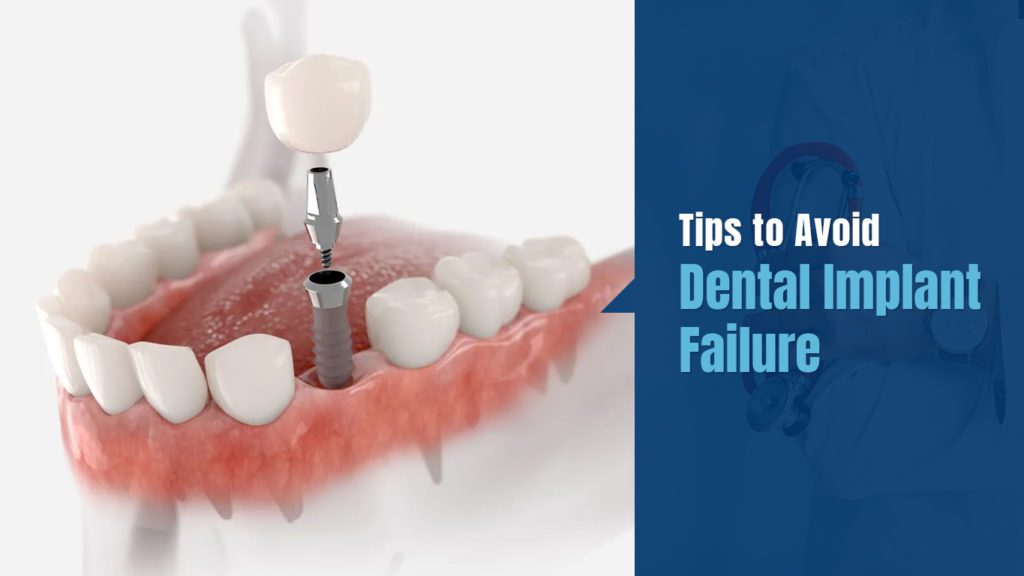 Tips-to-avoid-dental-implant-failure