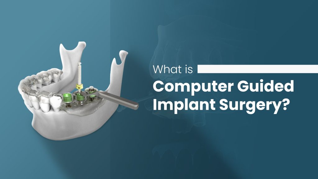 Computer Guided Implant Surgery