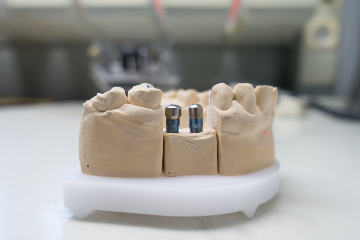 Dental Implant