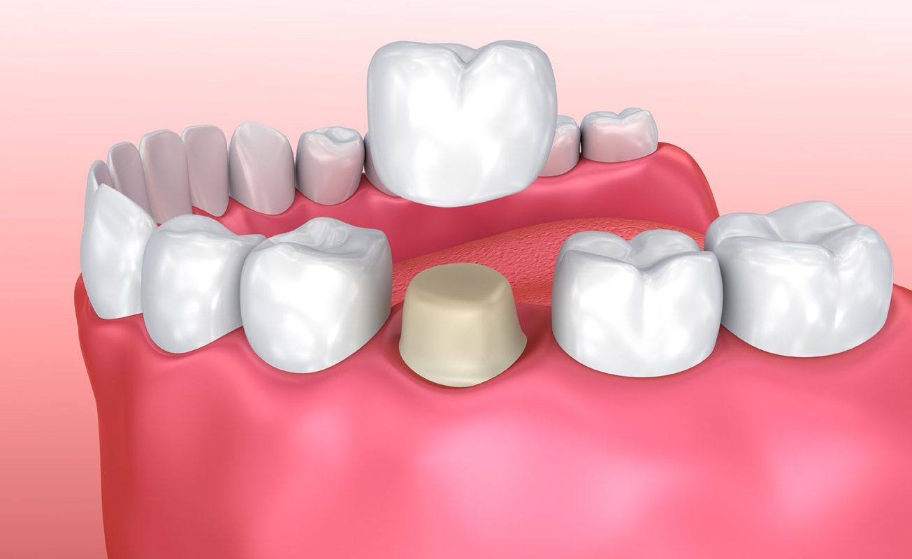 Dental crowns