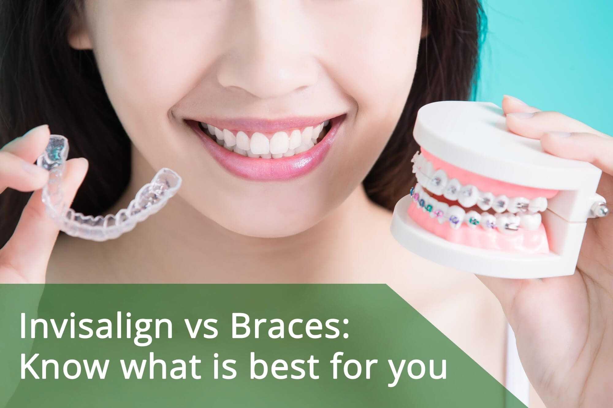 Invisalign vs Braces Know What is Best for you