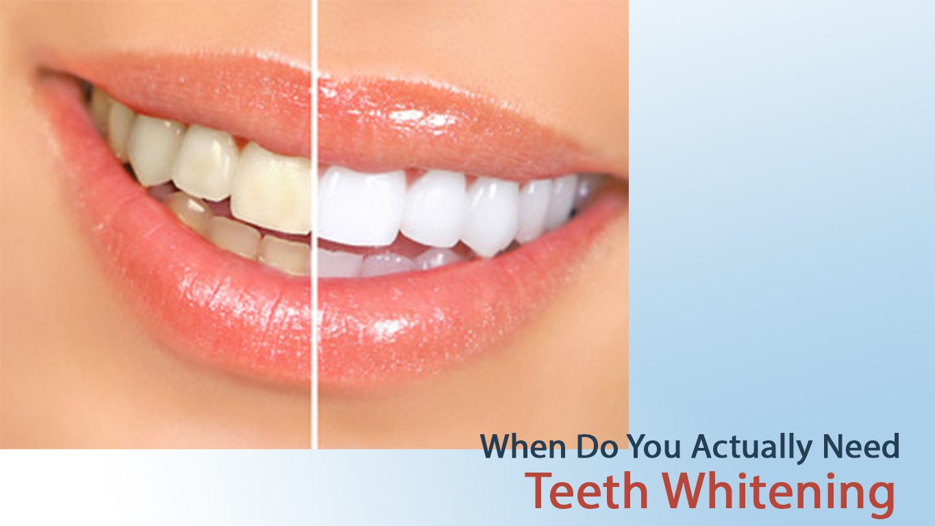 teeth whitening