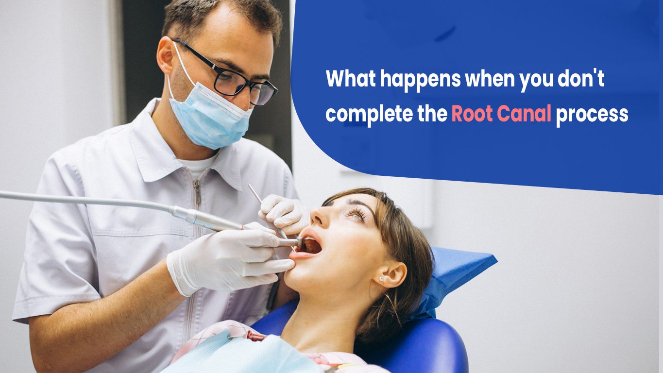 root canal