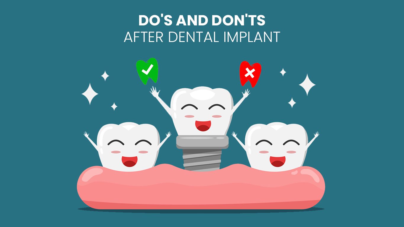 Dental Implant