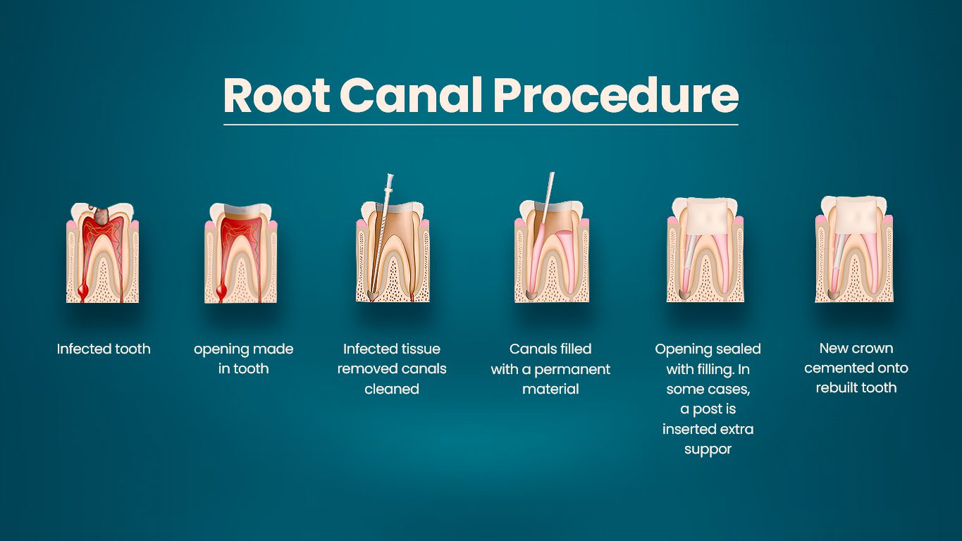 Root Canal: Procedure, Benefits, Aftercare