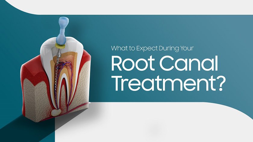 Image of Root Canal treatment