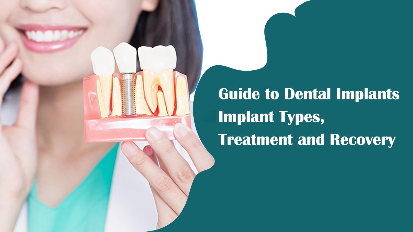 Image of Guide to Dental Implants