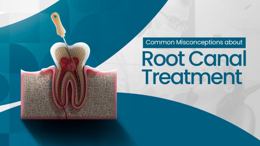 Root canal treatment illustration debunking common myths.