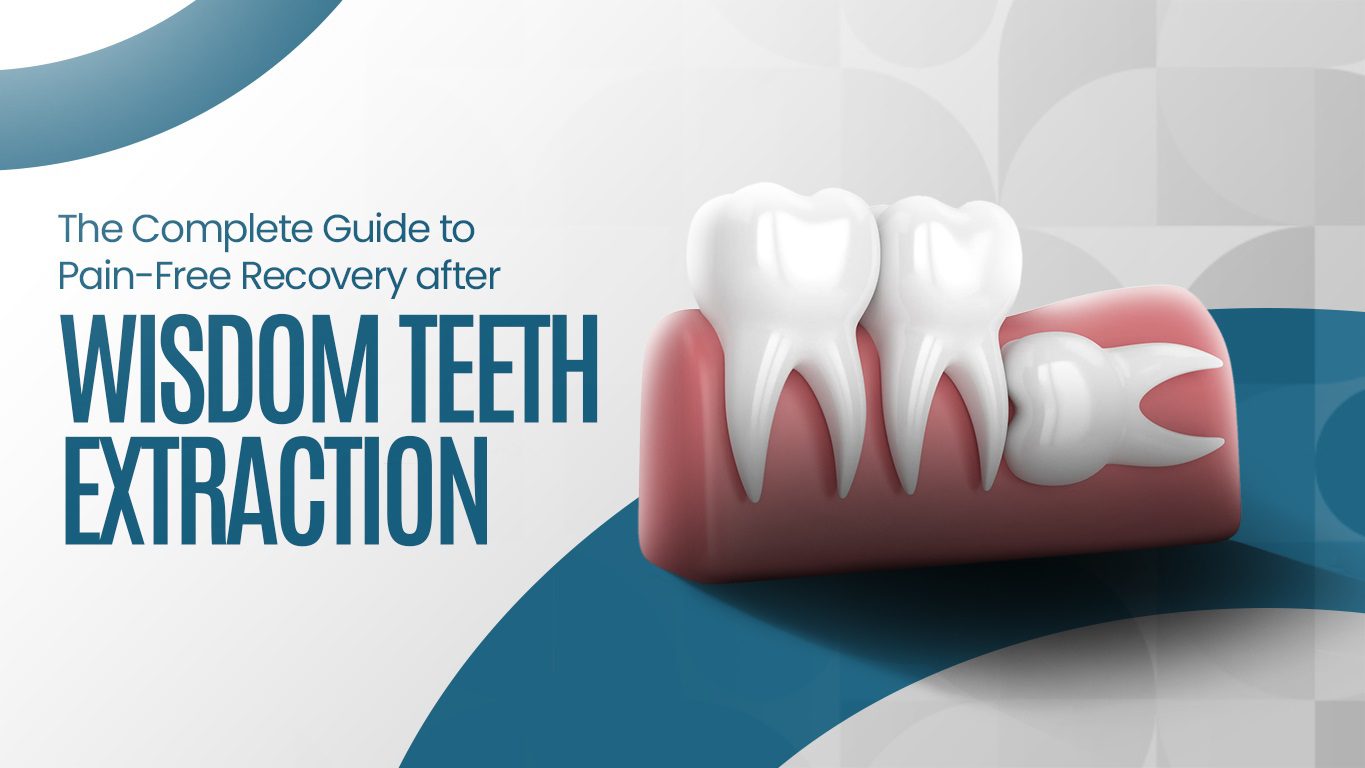 Illustration of impacted wisdom teeth and extraction guide