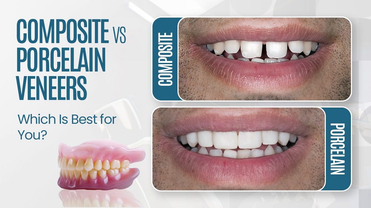 Composite vs. porcelain veneers comparison with before-after